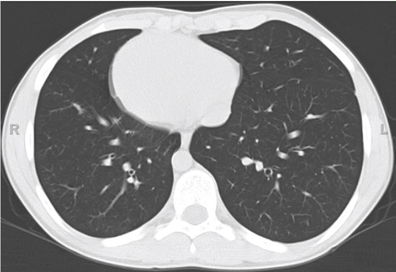 Computed x-ray tomographic image of the chest that showed dextrocardia with mirror image branching of the thoracic aorta, clear lung fields, and no bronchiectasis or atelectasis. More caudal images revealed left-sided liver and single, right-sided spleen.